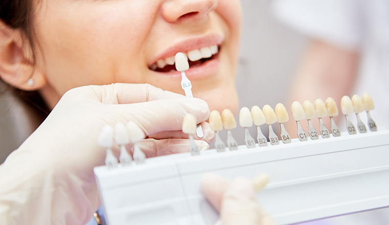 Selection of the correct tooth color for professional cosmetic bleaching at the dentist