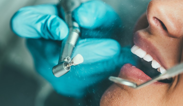 Teeth Polishing